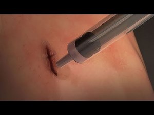 MeTro – elastic hydrogel for surgical applications