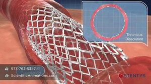 3D Animation of Coronary Stent Procedure https://www.youtube.com/watch?v=t-zCBKRg7Cs This interactive animation describes about "coronary stent procedure" made by scientific animations. Stents are small expandable tubes used to treat weakened or narrowed arteries in the body. Coronary artery disease is common cause of morbidity and mortality in the world. A balloon angioplasty with stent insertion is a procedure used to increase the amount of blood flowing through the coronary artery. | Clinical