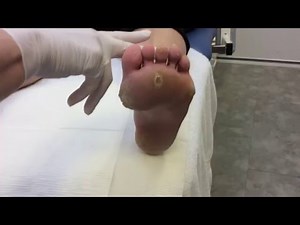 Doorgezakte voorvoet, spreidvoet