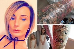 Glasgow mum's botched tattoo removal leaves daughter 'PETRIFIED' of her arm