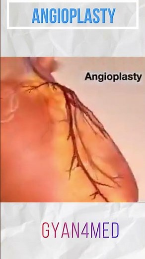 Coronary angioplasty (Femoral Access)