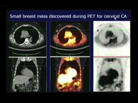 PET CT Scan