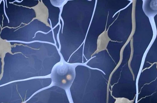 Signs and symptoms of Lewy body dementia - Mayo Clinic News Network