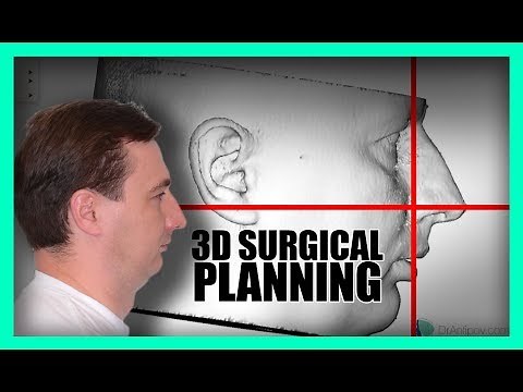 3D Virtual Surgical Planning (ORTHOGNATHIC)