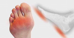 Schade aan het vetkussen onder de voet