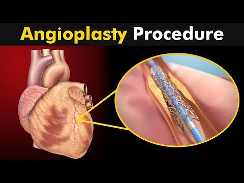 How Angioplasty Procedure is performed?